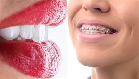 Veneers vs. Braces (Which One Is Right For You?) - Mouth Ninja