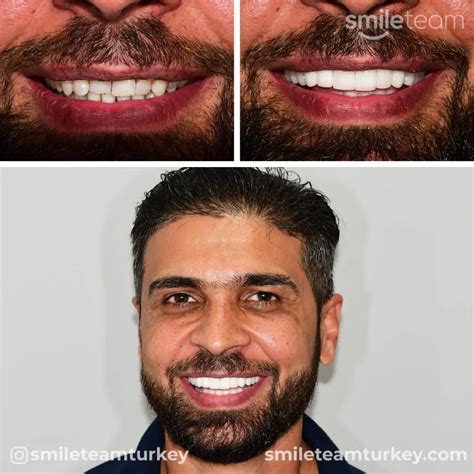 Turkey Teeth Before After Photos | Smile Team Turkey