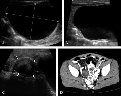 Mesenteric cyst and mesenteric pseudocyst. A and B, A 2-week-old girl ...