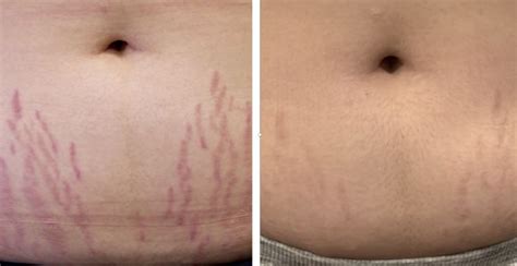 Stretch Mark Laser Removal: Before And After Results [Real Cases] | Heliotherapy Research Institute