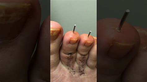 Dr. removing pins from toe surgery WARNING - GRAPHIC! | Pins, Graphic, Toes