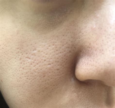 Please help!! Very enlarged pores/mini craters on cheek, nose, and ...