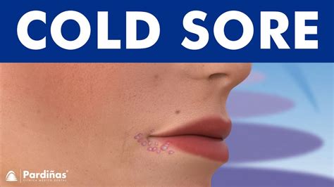 COLD SORES - Causes and symptoms of herpes on lip © (8K) - YouTube