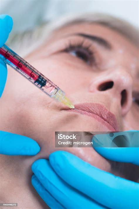 Hyaluronan Injection Face Treatment Stock Photo - Download Image Now - Beauty, Human Lips ...