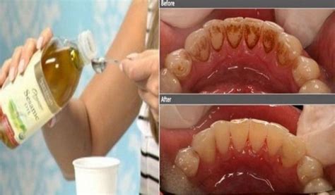 The oldest way to clean the teeth is by oil pulling. This method was ...