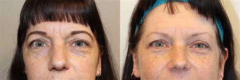 Eyelid Surgery, Eyelid Lift (Blepharoplasty) - Dr Anzarut Plastic Surgery, British Columbia, Canada