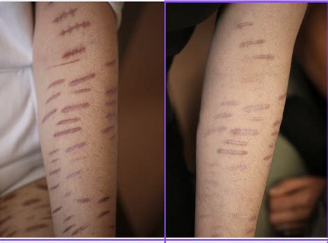 Self Harm Scars On Arms