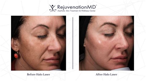 What to Expect from a Halo Laser Treatment | RejuvenationMD