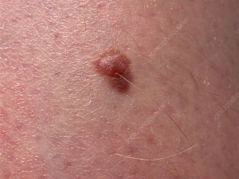 Dysplastic nevus - Stock Image - C006/3591 - Science Photo Library