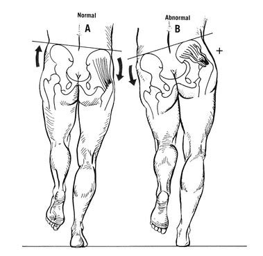 Trendelenburg Test - Examination of the Hip - Physical Therapy Web