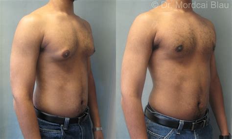 Adolescent Gynecomastia - Before and After Photos ⋆ Gynecomastia USA