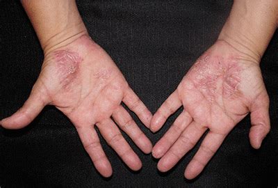 Painful pustules on hands | Clinician Reviews