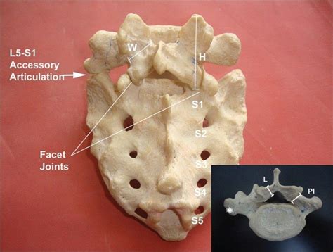 Transitional Anatomy At The Lumbosacral Junction - Anatomy Book