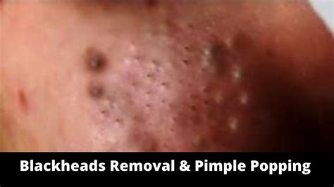 Pimple Popping Videos 2024 Blackheads Popping - Sadie Collette