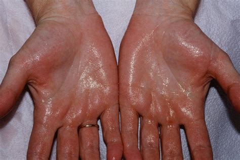 All You Need To Know About Hyperhidrosis - Causes, Symptoms And Treatments