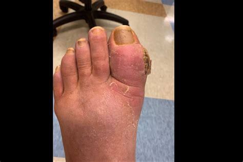 Ortho Dx: Erythema, Swelling, and Pain of the First Toe - Clinical Advisor