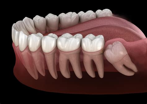 Impacted Wisdom Teeth - Flowood, MS: Oral & Facial Surgery of Mississippi