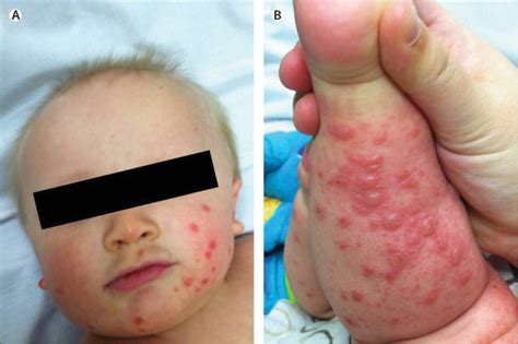 Atypical hand, foot, and mouth disease: a vesiculobullous eruption ...