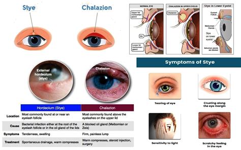 Chalazion Treatment Home Remedies