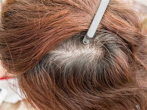 Thinning Hair Can Have Myriad Causes - University Health News