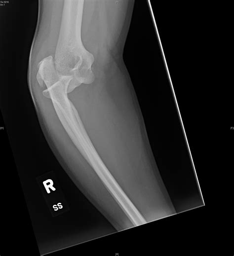 Lateral Epicondyle Fracture - JETem