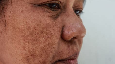 Melasma: Causes, symptoms, pictures & treatment