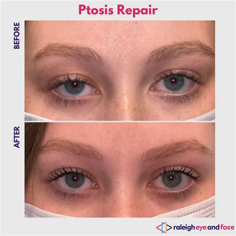 Ptosis Repair Gallery | Ptosis Repair Specialist Raleigh — Raleigh Eye and Face