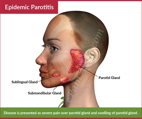 Mumps or Epidemic Parotitis|Causes|Risk Factors|Characteristics ...