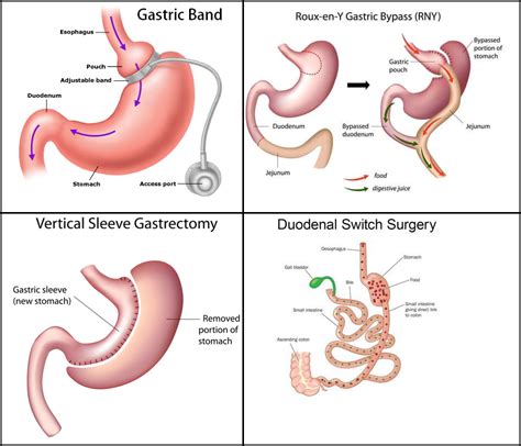 A look at four different Bariatric Surgeries - Dr. Mohit Bhandari - Medium