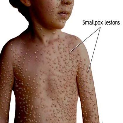 Smallpox Symptoms