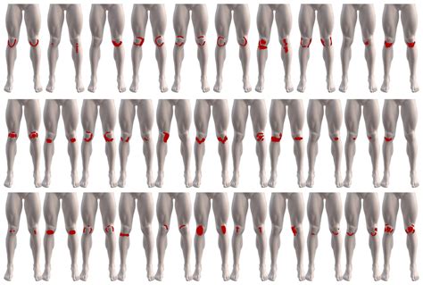 Capturing patient-reported area of knee pain: a concurrent validity study using digital ...