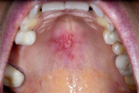 Mouth Ulcer - Causes, symptoms, Treatment & cure - Museum Dental Center