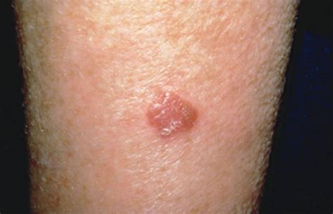 White Spots On Skin Cancer