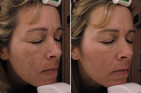 Hyperpigmentation On Face Treatment - Doctor Heck