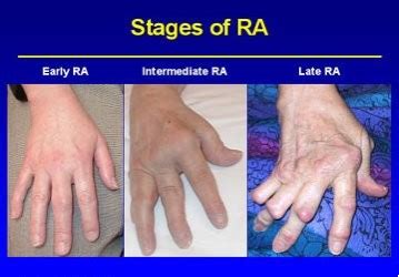 Rheumatoid Arthritis - Physiopedia