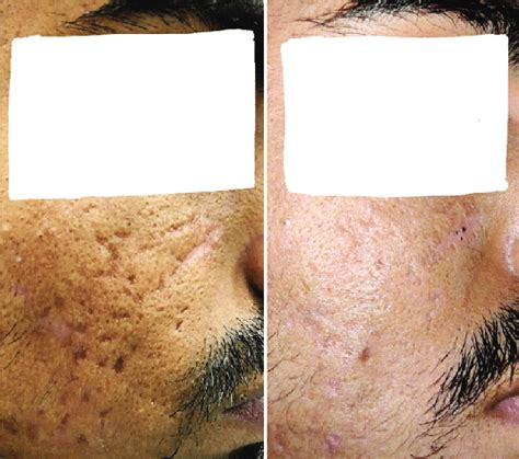 (a) Atrophic rolling and boxcar acne scars before treatment. (b ...