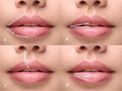 Lip Filler Techniques: All You Need To Know