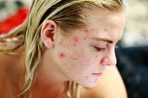 Why is the PCOS Acne so Stubborn?