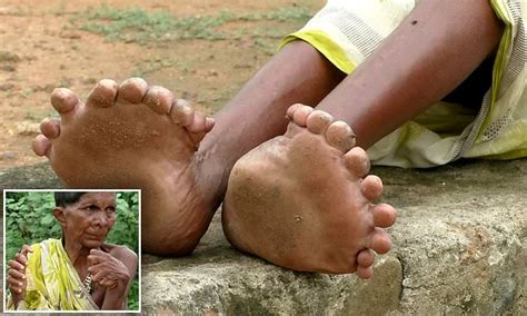 Woman, 63, born with 19 TOES and 12 fingers | Daily Mail Online