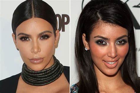 Kim Kardashian Plastic Surgery Journey - Before & After (2023)