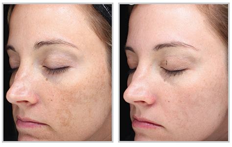 Melasma Boise | Pigmentation Treatment In Idaho | Renu MediSpa