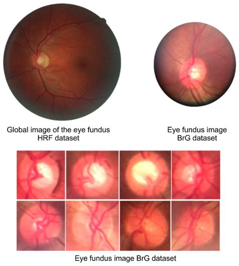 Healthcare | Free Full-Text | Detection of Glaucoma on Fundus Images ...