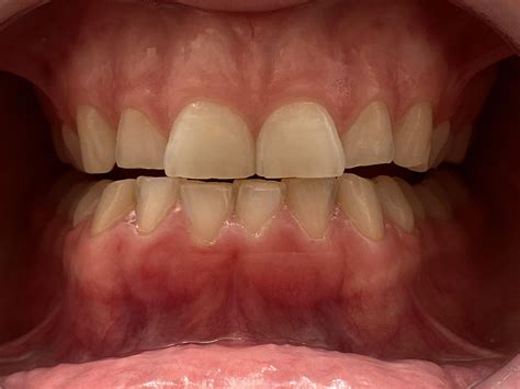 Help! Are my gums receding on my bottom teeth? I’m on month one week three, one day in, and ...