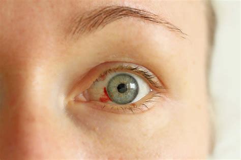 Corneal Laceration: Causes, Symptoms, Diagnosis And Treatment - accuspire