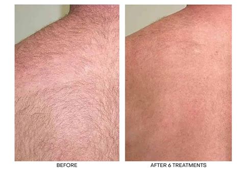 Best Laser Hair Removal Toronto | Laser Hair Removal Near Me