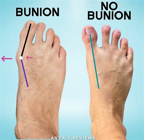 How To Help Your Bunions If You Don't Want Surgery | Anya's Reviews