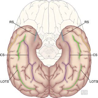 Temporal lobe anatomy: eight imaging signs to facilitate interpretation of MRI | Request PDF