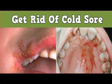 Get Rid Of Cold Sore, What Is A Cold Sore, Cold Sores On Tongue, Lip Cold Sore, Cold Sore Tongue