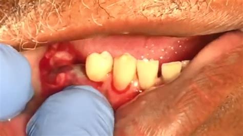 abscessed gum – abscess on gums – Swhshish