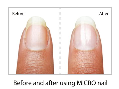 Buff and Shine Nails in just Minutes – MicroNail